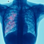 x-ray of chest show cavity at right lung and interstitial infiltrate both lung due to TB infection